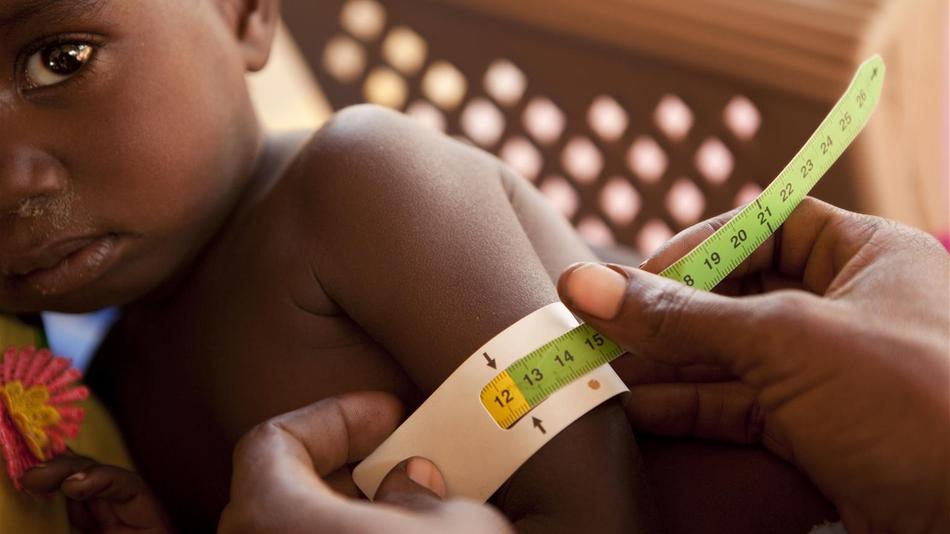 Mangelernährung, UNICEF